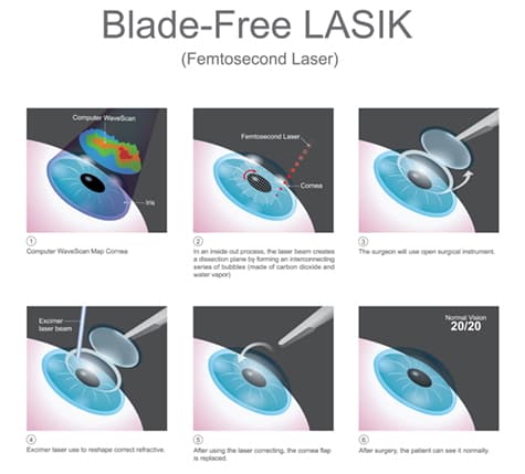 Diagram of Blade-free LASIK steps