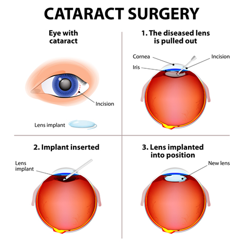 Cataract Surgery Medical Illustration