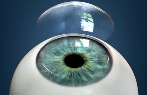 Corneal Transplant