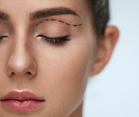 Woman with eyelid surgery marker