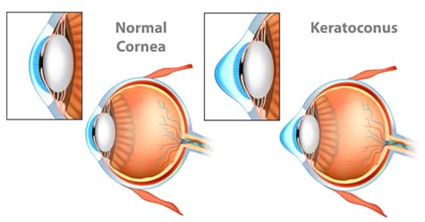 Diagram of Normal Cornea vs Cornea with Keratoconus