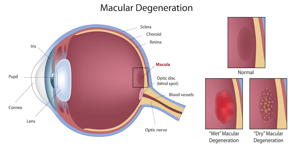 Diagram of Macular Degeneration in the Eye