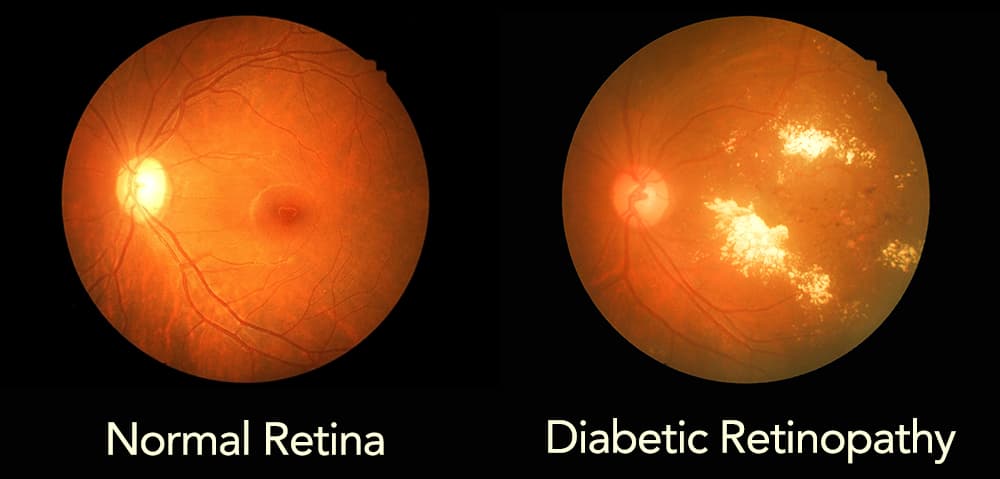 Photo of a normal retina compared to a diabetic retina