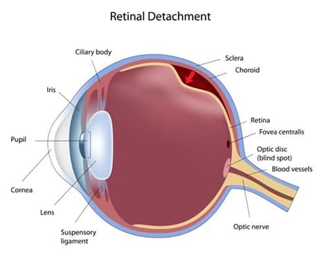 Diagram of Retinal Detachment
